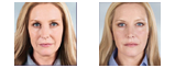 Pre and Post treatment information