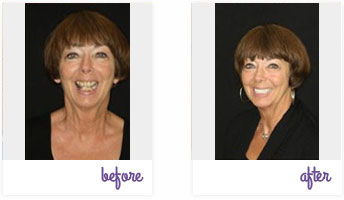 Before & After Pictures West Chester - Porcelain Crowns 02