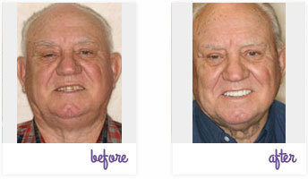Before & After Pictures West Chester - Porcelain Crowns 03
