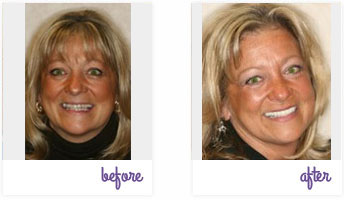 Before & After Pictures West Chester - Porcelain Crowns 04