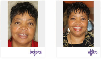 Before & After Pictures West Chester - Dental Implants 01