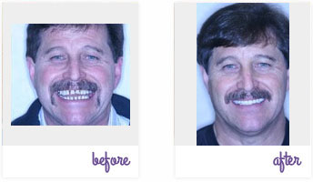 Before & After Pictures West Chester - Dental Implants 02