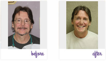 Before & After Pictures West Chester - Dental Implants 03