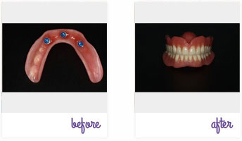 Before & After Pictures West Chester - Dental Implants 04