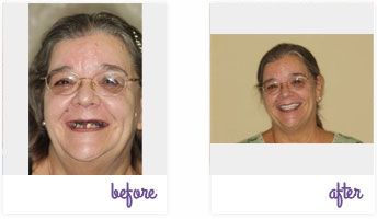 Before & After Pictures West Chester - Dental Implants 05