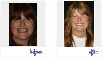 Before & After Pictures West Chester - Porcelain Veneers 01