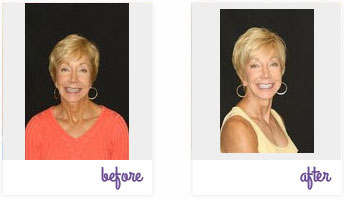 Before & After Pictures West Chester - Porcelain Veneers 02