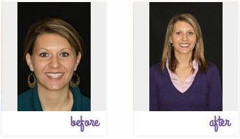 Before & After Pictures West Chester - Porcelain Veneers 03