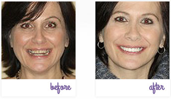 Before & After Pictures West Chester - Porcelain Veneers 04