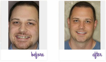 Before & After Pictures West Chester - Porcelain Veneers 05