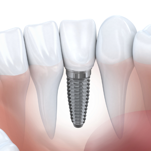 Implant Dentistry Charleston SC Photo