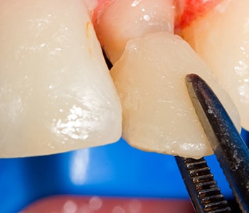 Dental Crowns in Greenwood