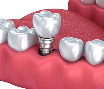 about Dental Implants dentist. At Dr. Christopher Griffin's office
