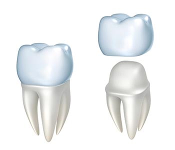 In Dentistry what is a Crown Greenwood SC