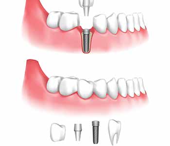 what are dental implants