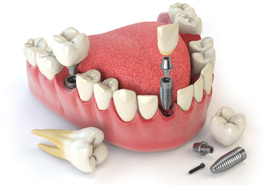 Tooth implant