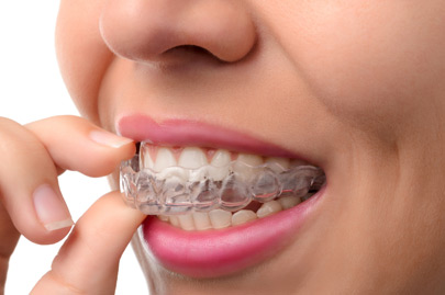 Woman wearing orthodontic silicone trainer