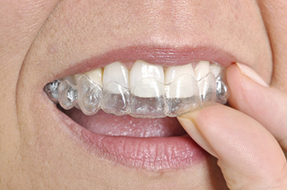 Woman wearing orthodontic silicone trainer