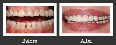 Before and After Crowns and Laminates