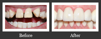 Before and After Porcelain Veneers and Crowns