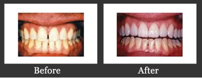 Before and After Porcelain Veneers