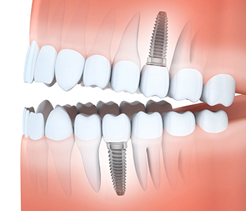 The advantages of dental implants vs. dental bridges for patients in the Alpharetta area