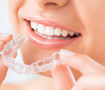 Alpharetta dentist helps his nearby patients understand the costs, reviews, and other considerations of Invisalign