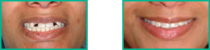 Dental Implant Center in Oakland County - Before and After 01