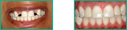 Dental Implant Center in Oakland County - Before and After 02