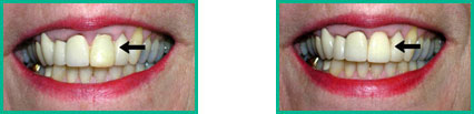 Dental Implant Center in Oakland County - Before and After 03