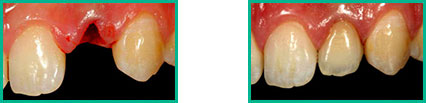 Dental Implant Center in Oakland County - Before and After 04