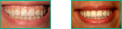 Dental Implant Center in Oakland County - Before and After 07