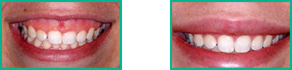 Dental Implant Center in Oakland County - Before and After 08