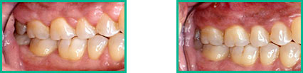 Dental Implant Center in Oakland County - Before and After 10