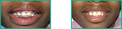 Dental Implant Center in Oakland County - Before and After 11
