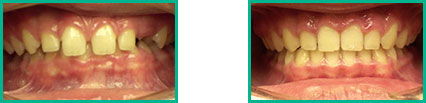 Dental Implant Center in Oakland County - Before and After 13