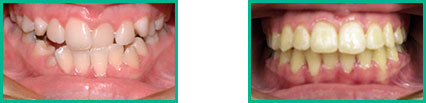 Dental Implant Center in Oakland County - Before and After 14