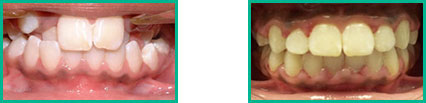 Dental Implant Center in Oakland County - Before and After 15