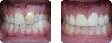 Smile Gallery Burr Ridge -  Before After 01