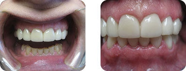 Smile Gallery Burr Ridge -   Before After 02