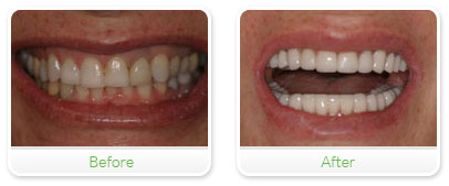 Smile Gallery Las Vegas - Full Mouth Reconstruction 04