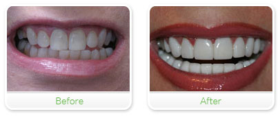 Smile Gallery Las Vegas - Upper & Lower Veneers 05