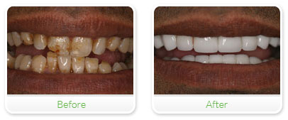 Smile Gallery Las Vegas - Full Mouth Reconstruction 06