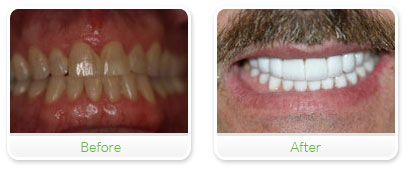 Smile Gallery Las Vegas - Upper & Lower Veneers 08