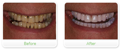 Smile Gallery Las Vegas - Full Mouth Reconstruction 10
