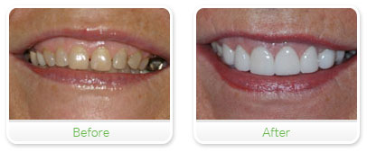 Smile Gallery Las Vegas - Upper Recon & Implants 14