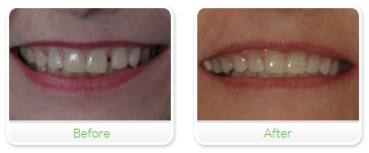 Smile Gallery Las Vegas - Invisalign 15
