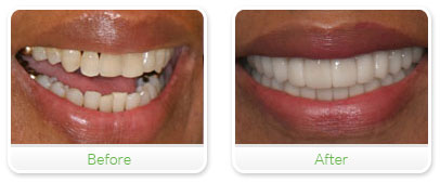 Smile Gallery Las Vegas - Full Mouth Reconstruction 16