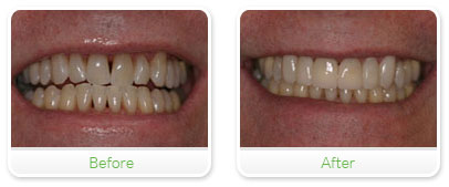 Smile Gallery Las Vegas - Upper Veneers 18