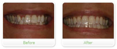 Smile Gallery Las Vegas - Invisalign 21